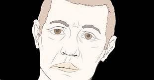La paralisi di Bell